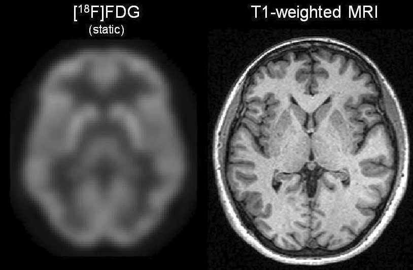 Example co-registered FDG_PET and MRI of the brain.